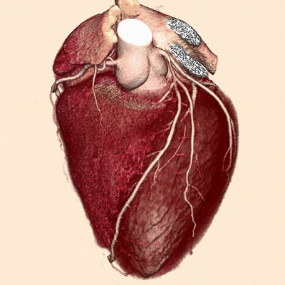 冠動脈３Ｄ-ＣＴ