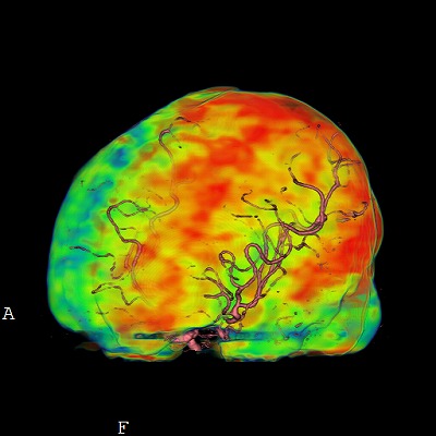 脳血管ＣＴ
